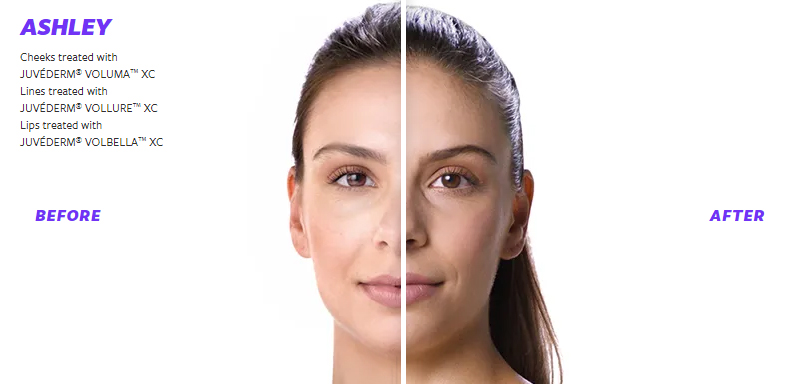 Juvederm Before & After 1